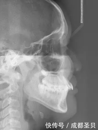 史上最全牙齿正畸流程,消除了我对牙医99%的