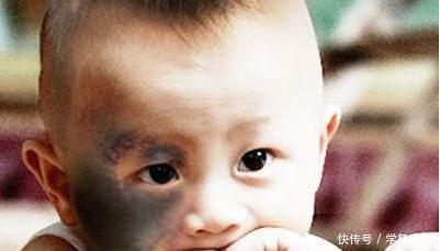 宝宝生下来脸上有块明显的大胎记