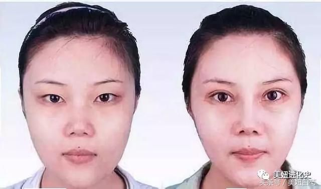 为什么她做了双眼皮却没有变美？