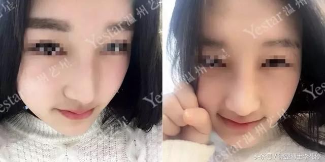 实锤：国民闺女，整容了？