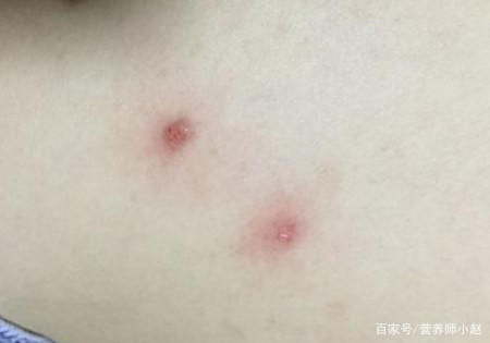  『长痘』为啥有些人总是后背长痘？或是这些因素在“捣鬼”，你中招了吗？