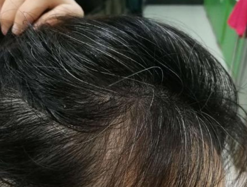  「白头发」经常长白头发是因为血热？未必如此，或许是毛囊里缺了一些东西