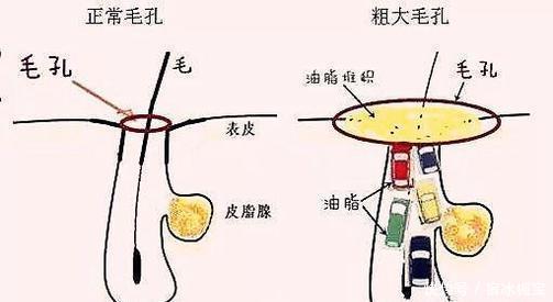  【没错】想要告别丑陋的黑头，皮肤科医生教你4个步骤，照着做准没错