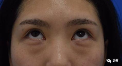 90后的郑爽关晓彤眼袋都要掉地上了，快来个医生救救她们吧!