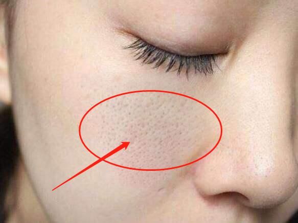 女人脸上有螨虫别担心，每晚抹点便宜小物，毛孔缩小提亮肤色