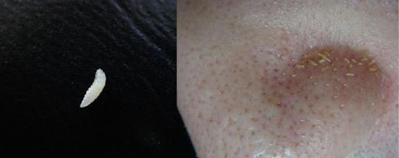 鼻头里挤出这么多“小黄粒”,证明脸上螨虫过亿，3招教你逼退螨虫