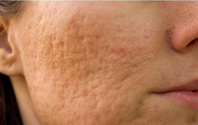 毛孔是怎么变大的?9个自然缩小毛孔的方法，更显年轻感