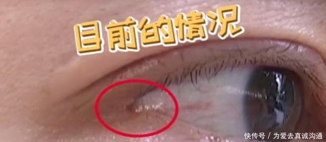  「术后」姑娘做“开眼角”，术后却感觉眼睛不对劲医生确实少缝了一针
