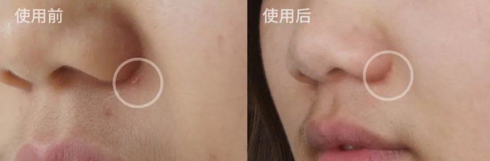 令人骄傲的“中国制造”还不多,但这中国农科院研发的抗痘神器肯