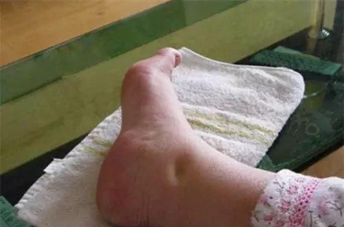  「保护肾脏健康」尿毒症，多数是“拖”出来的，身体出现5种症状，最好去做个尿检