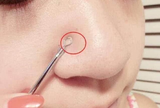 长了“黑头”怎么办？教你2招，让黑头自己跑出去，还不伤皮肤！