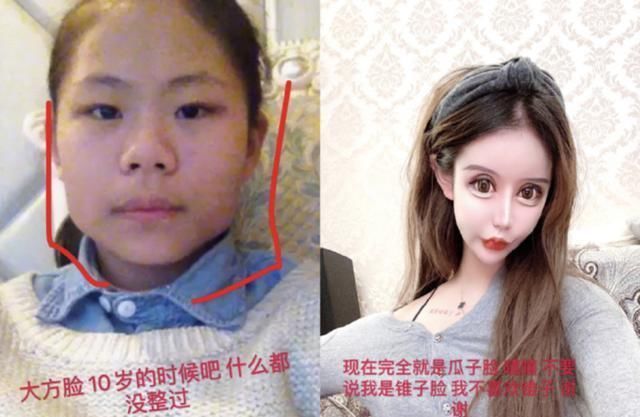  女生：16岁女生整容60次花费过百万割双眼皮、隆鼻、磨骨变做人形芭比
