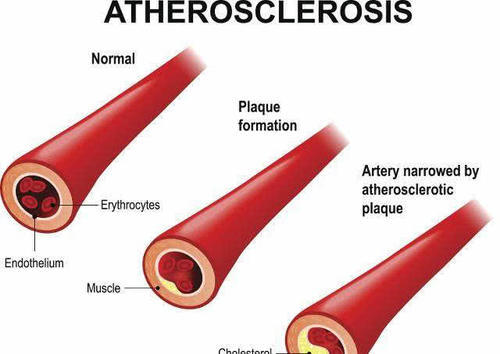 “人与血管同寿”！40岁以后，养好血管需做好这8件事