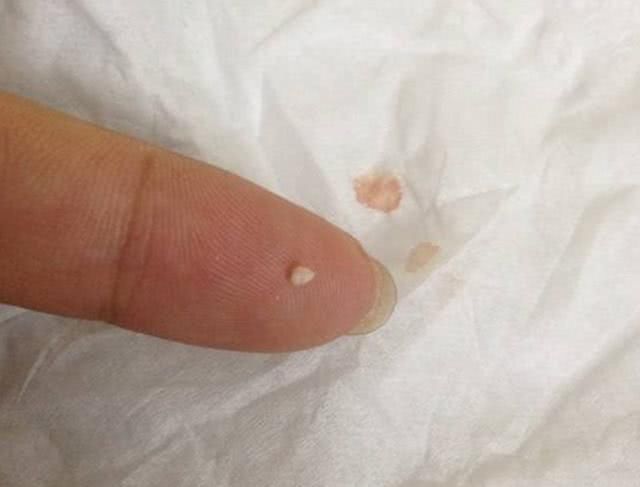 脸上成螨虫窝，痘痘会疯长，不必去医院，教你3招快速灭螨祛痘