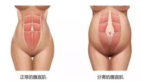 腹直肌分离的常见误区 与4步完整处理方案 康复医学网 雪花新闻