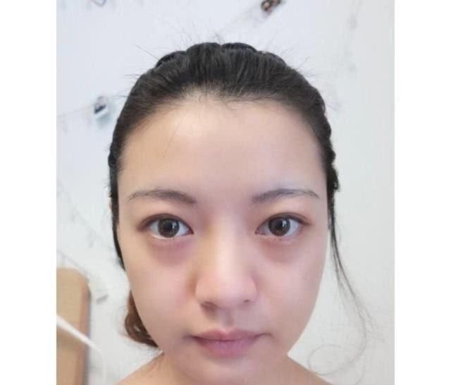  「科普」五种眼部问题科普解析，让你一双眼睛改变一张脸