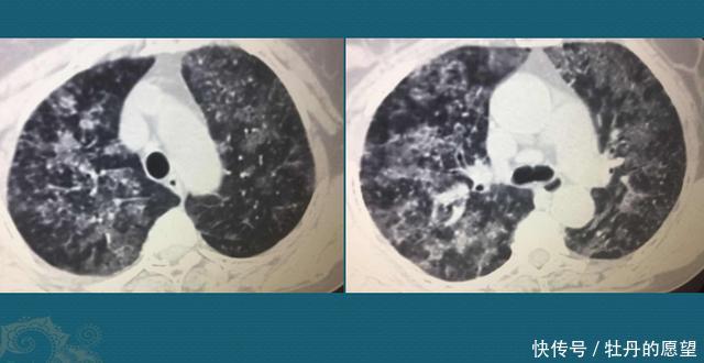 养宠物也得看体质,这个28岁小伙不能养狗,肺过