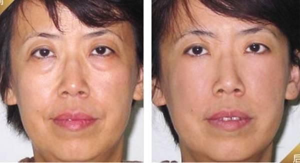 有一种神奇医用眼膏，120秒消眼袋，效果不输玻尿酸