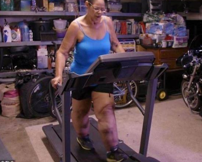 从600多斤到200多斤，减肥成功却留下一身赘皮，洗完澡都会发臭！