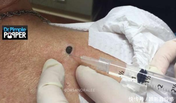 女儿带老母亲去医院挤黑头,拔出来那瞬间,看得