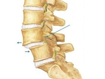 腰椎滑脱怎么治疗最好