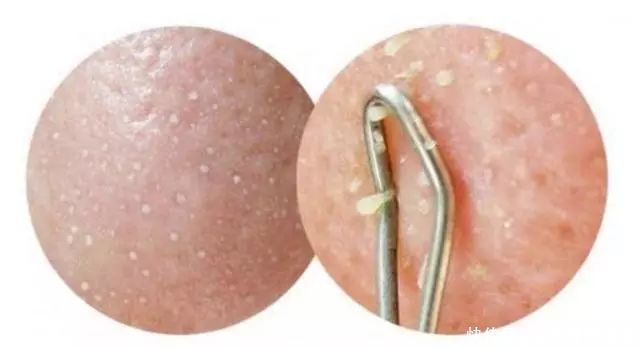 你知道,脸上的“小疙瘩”,挤出来的“白色条状物”,是什么吗?