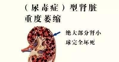 『血管内皮细』尿毒症是怎么得上的?前兆是什么?