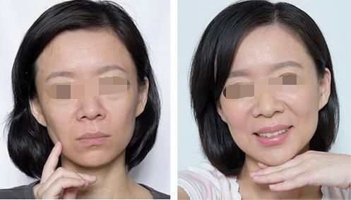 做射频除皱价格要多少