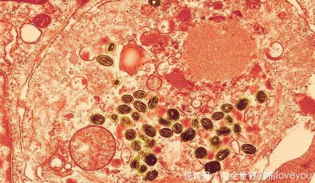  世界卫生组织@曾造成数亿人死亡的“天花”，为什么能被彻底消灭掉！