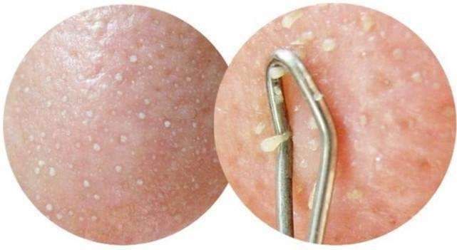 脸上起这种疙瘩, 会痒, 抓破后还能掉出硬邦邦米粒, 居然是这3物