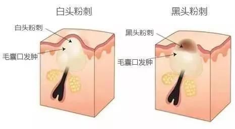 黑头粉刺+毛孔粗大?这份良心祛黑头指南收好了!