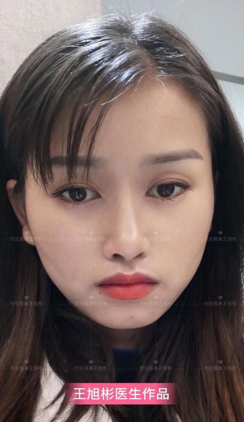  术后■鼻头肥大、山根低、没鼻梁，肋软骨隆鼻后变化有多大？
