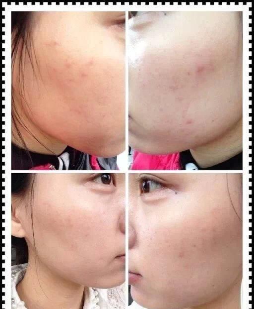  #脸上#知道这7个凶手后，脸上痘痘无影踪，白白教你安全祛痘