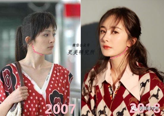 “整牙到底能不能瘦脸”终于有了权威结论,杨幂竟是被冤枉的?