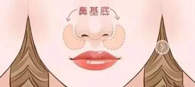 填充:侧面不够立体,可能是鼻基底的问题