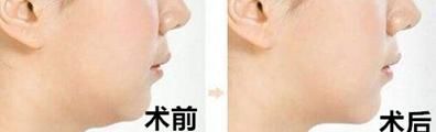  『双下巴』解决“双下巴＂, “脖子有皱纹”答案都在这儿