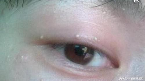 下巴紧绷后的白色颗粒到底是什么?