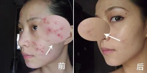 拔出黑头粉刺，地毯式清洁肌肤，还能缩小毛孔!素颜也自带妆容