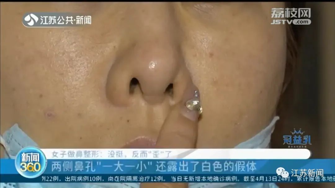  修复@瑟瑟发抖！女子整容后鼻头斜了，修复一下结果鼻孔又歪了！