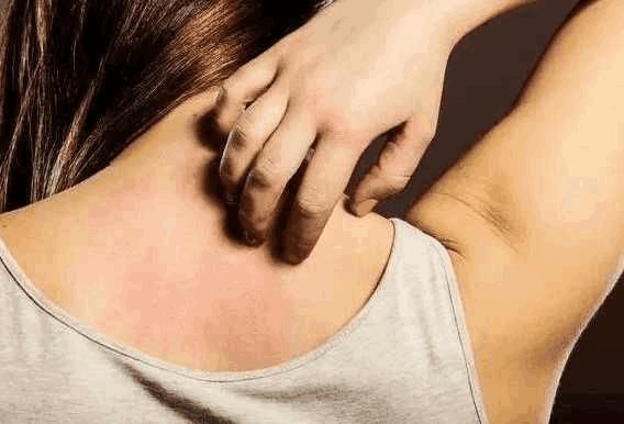 警告：后背有这5个“奇怪的现象”, 是螨虫在向你“打招呼”了