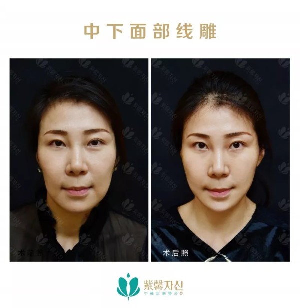 苏州紫馨逆龄术--让年龄成为秘密，悦升线苏州区首发