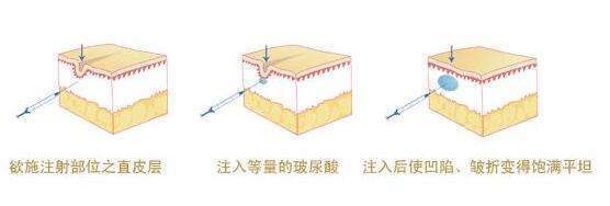 「自体脂肪丰额头」额头扁平,侧颜不好看怎么办?这样做,让你侧颜立体感爆棚!