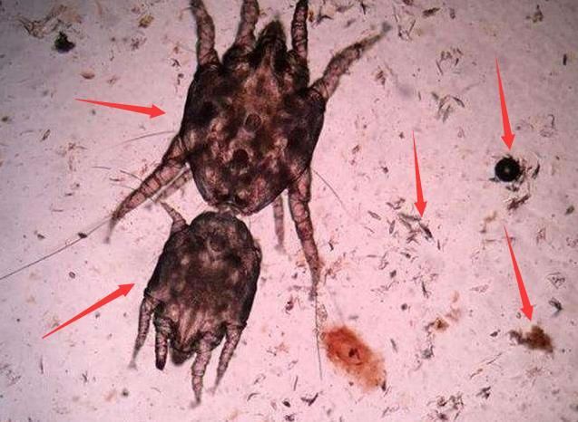 鼻子上总是挤出小米粒，因为有螨虫在钻孔，再不解决毛孔没救了