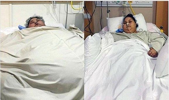 女子体重1000斤，在床上躺25年，去医院需使用吊车和卡车