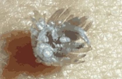 身上长了“瘊子”?不要紧!抓一只螳螂,它会给你吃的干干净净!
