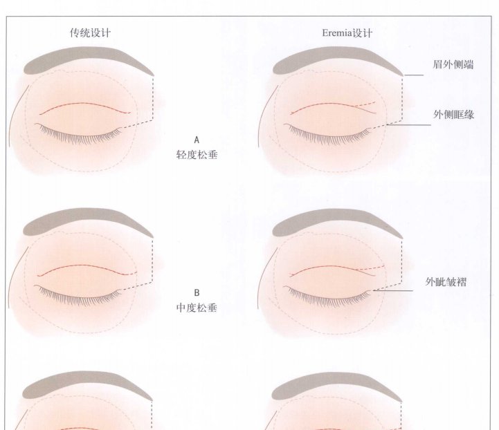  「睑皮肤松弛」眼部美容仪对去眼袋有用吗