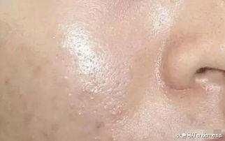 毛孔粗大像“筛子”, 说明上万螨虫在“打洞”, 简单祛除只需3招