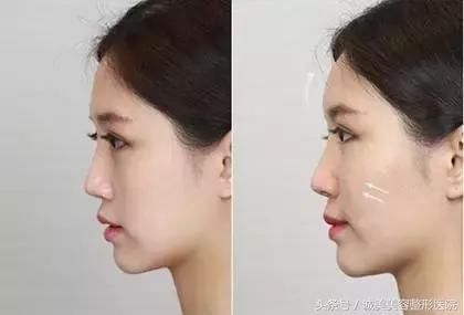 苹果肌和高颧骨之间有超大区别，你分得清楚吗？