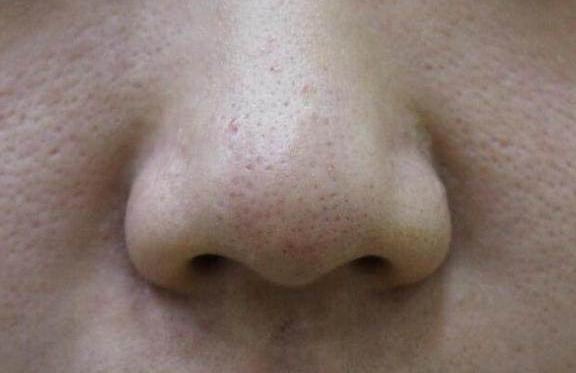 睡醒后出现4迹象, 不要怀疑, 说明毛孔已被螨虫堵得水泄不通