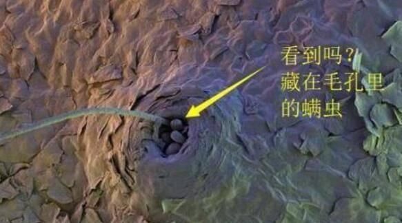 毛孔粗大:4种人毛孔越来越粗,像拔过毛的鸡皮,简单的技巧可缩小毛孔